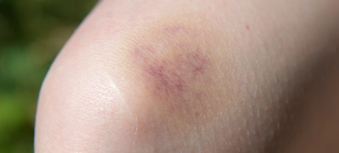 Einmal blöd gestoßen, schon hat man einen blauen Fleck. Mit der Zeit wird der dann nicht nur blau und lila, sondern auch braun, grün oder gelb. (Foto: dpa)