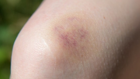 Einmal blöd gestoßen, schon hat man einen blauen Fleck. Mit der Zeit wird der dann nicht nur blau und lila, sondern auch braun, grün oder gelb. (Foto: dpa)